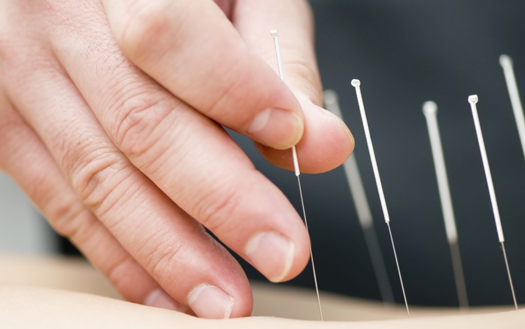 Acupuncture & Weight Loss