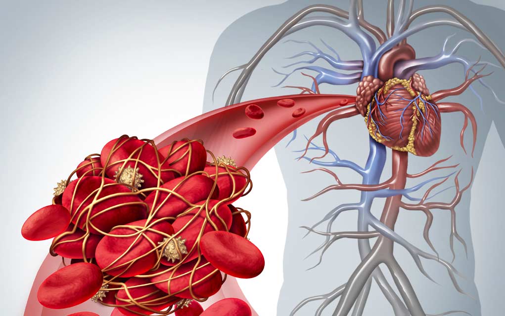 8 Signs You May Have a Blood Clot